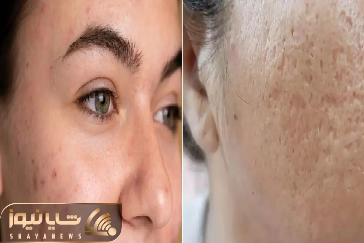 بهترین کرم برا از بین بردن جای جوش و لک های تیره و قهوه ای صورت/ پوستی شفاف و آینه ای