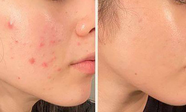 چگونه در خانه جوش را درمان کنیم ؟ | چند نکته طلایی برای درمان جوش