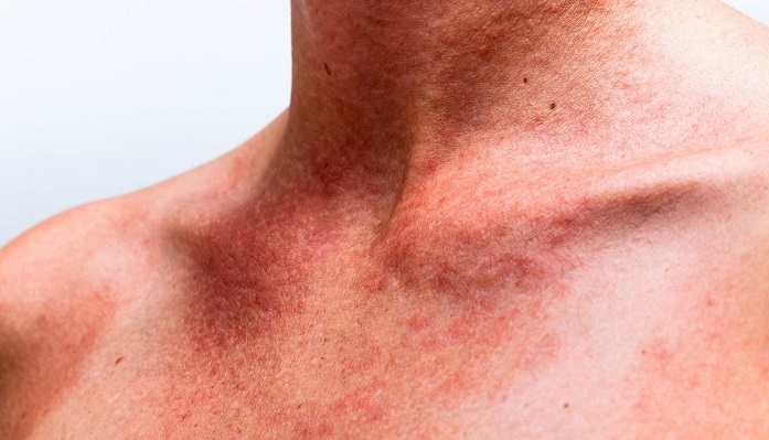 درمان های خانگی برای عرق سوز شدن | با این روش ها از شر عرق سوز شدن خلاص شو